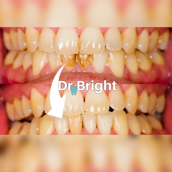 Densine™ - Dental Scaler