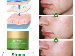 BREYLEE Acne Treatment Cream, Tea Tree Oil Acne Cream for Clearing Severe Acne, Breakout, Remove Pimple and Repair Skin (20ml,0.7oz)