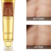 Scar Removal Cream - TCM Scar Cream for Surgical Scars, Acne Skin Care Cream, Acne Treatment Cream for Scars, Burns, Stretch Marks, Acne Spots