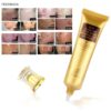 Scar Removal Cream - TCM Scar Cream for Surgical Scars, Acne Skin Care Cream, Acne Treatment Cream for Scars, Burns, Stretch Marks, Acne Spots
