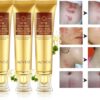 Scar Removal Cream - TCM Scar Cream for Surgical Scars, Acne Skin Care Cream, Acne Treatment Cream for Scars, Burns, Stretch Marks, Acne Spots
