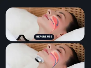 Health Care Sleep Apnea Aid Treatment Tool Breathing Corrector Smart Anti-snoring Device For Better Sleep