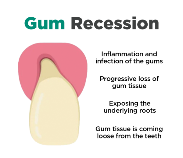 Stylo de blanchiment des dents JaySuing™