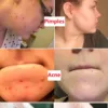Anti-Blackhead Green Tea Miracle Stick - Removes Blackheads from Face and Nose