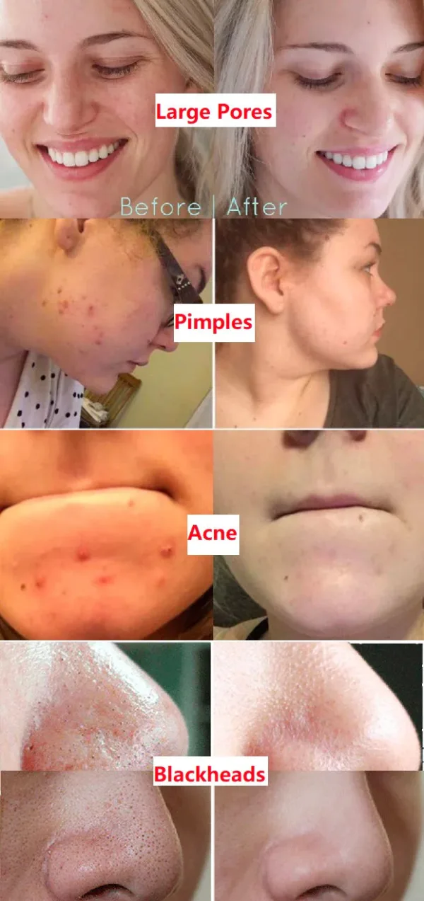 Anti-Blackhead Green Tea Miracle Stick - Removes Blackheads from Face and Nose